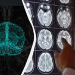 Proveržis gydant Alzheimerio ligą: mokslininkai padarė netikėtą atradimą