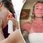 Oda pasakys „ačiū”: gydytojai pasakė, ką daryti, jei nudegėte saulėje